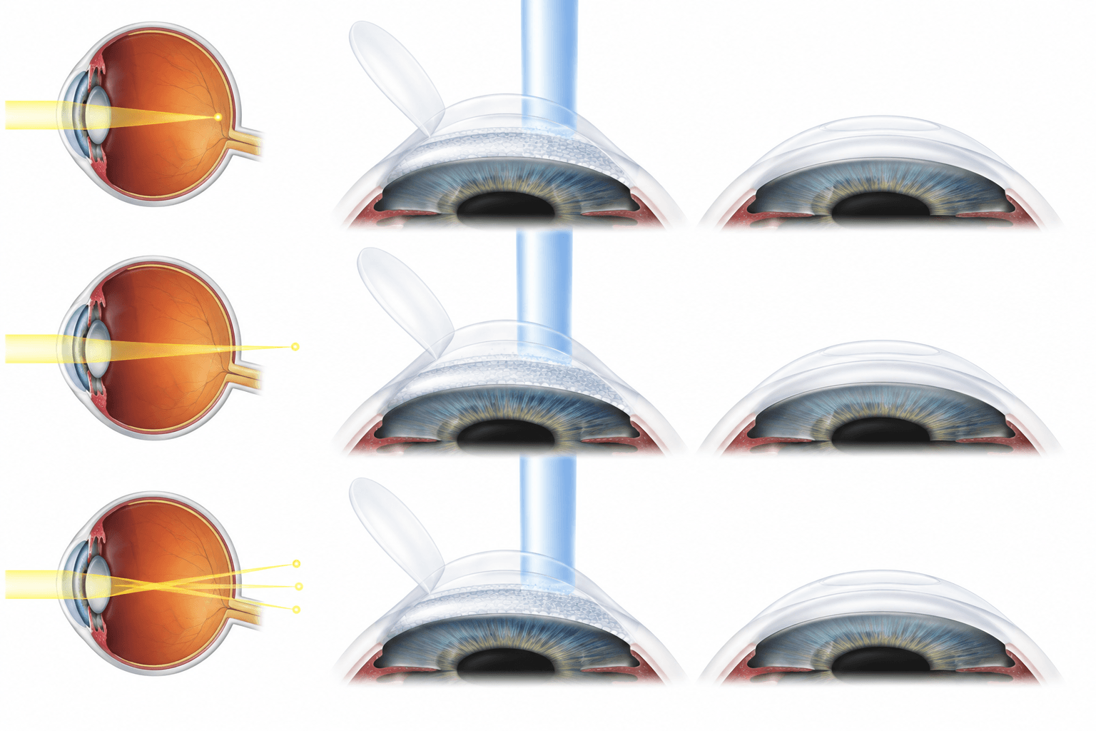 LASIK eye surgery cornea reshaping for vision correction