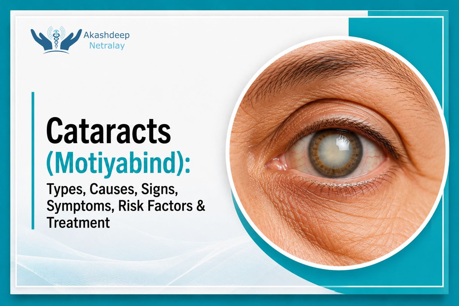 Cataracts (Motiyabind) eye condition showing symptoms, causes and treatment information