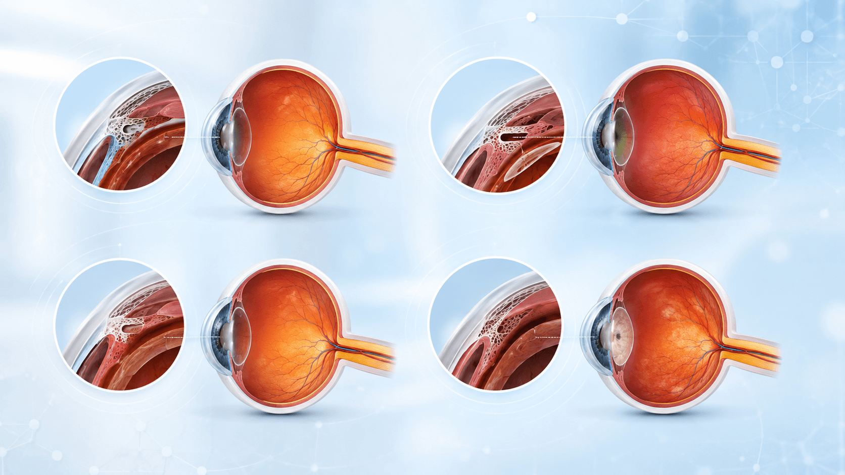 Medical illustration showing different types of glaucoma including open-angle, angle-closure, normal-tension, and secondary glaucoma.